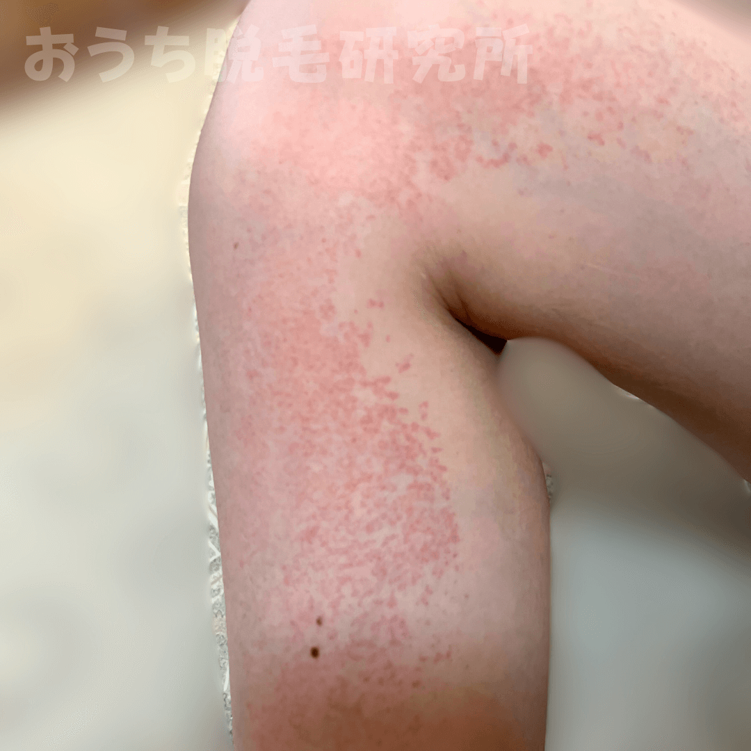 肌の赤み 敏感肌 ダメージ