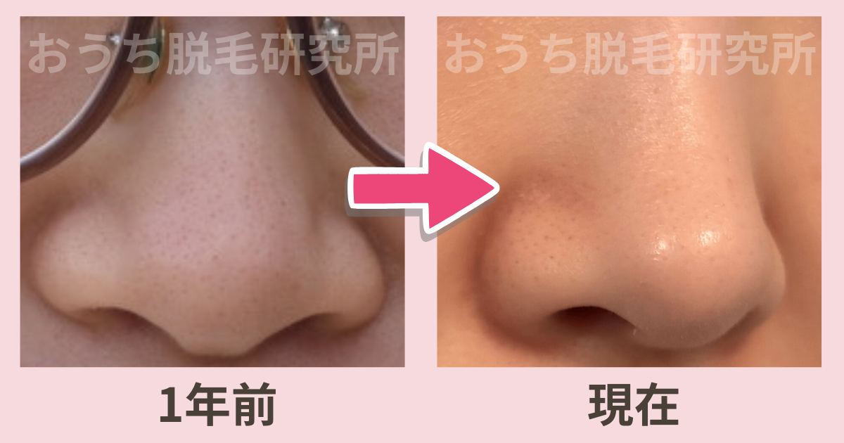 ケノン　いちご鼻　毛穴の黒ずみ　ビフォーアフター